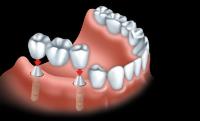 Ti Dental image 7